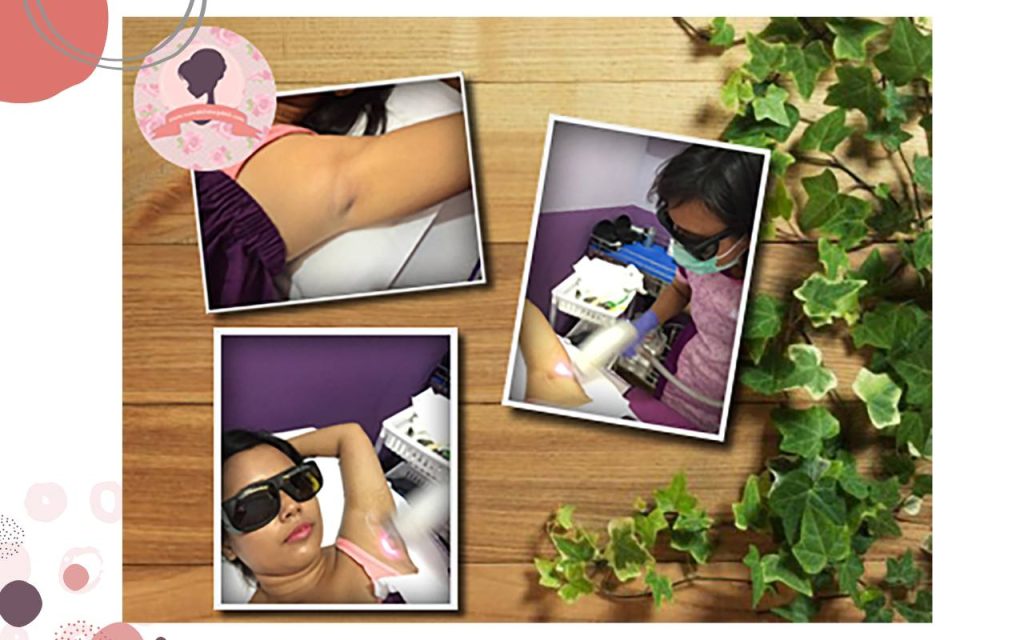 Proses-De-hair-laser-treatment