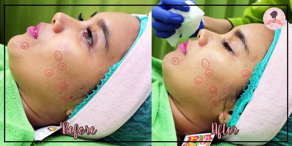Before and after ZAP Photo Facial Acne